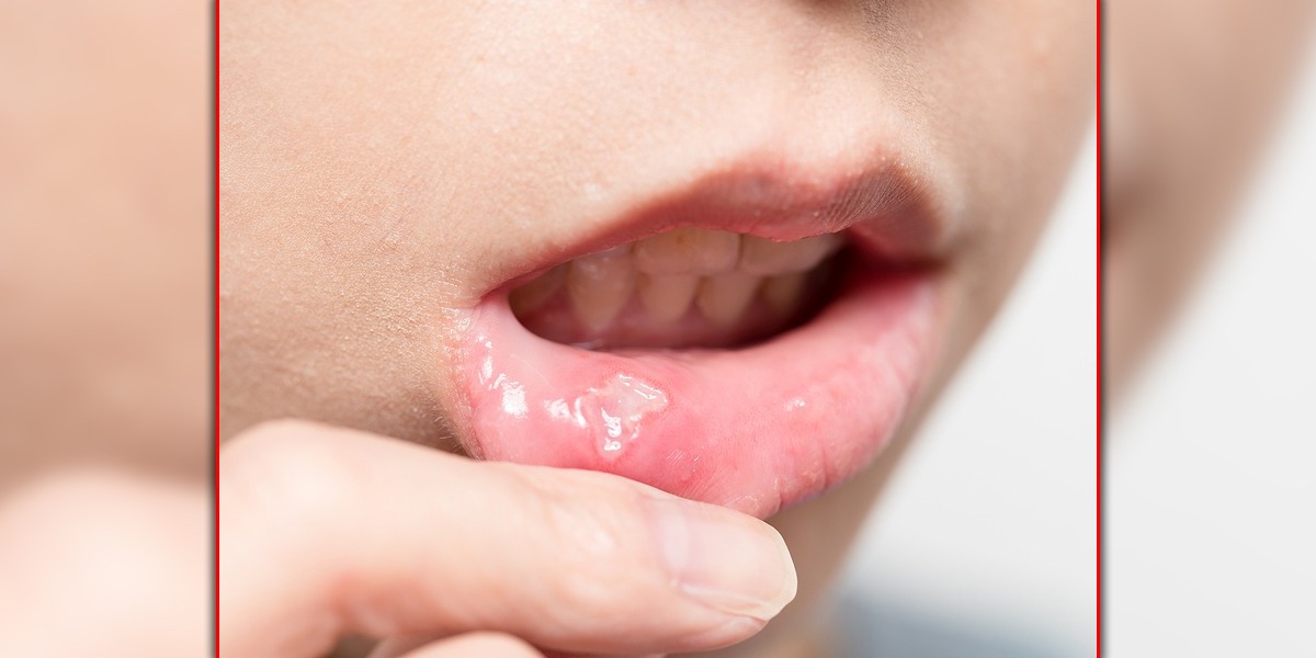 Oral Cancer: 22,000 Cases Reported In 10 Years In Karachi
